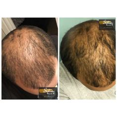 The Only Natural CCCA Alopecia Treatment & Hair Growth Solutions– BlackHairandSkincare Alopecia Diet, Alopecia Hair Growth, Diet Schedule, Traction Alopecia, Shaved Hair Designs, Skin Regimen, Hair Remedies For Growth, Skin Care Shopping