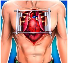 Discover the essential steps and insights for a successful open heart surgery recovery. Your path to healing starts here. - #Cardiacprocedurerecuperation #Cardiacsurgeryrecovery #Cardiacsurgeryrecoveryprocess #Copingwithheartsurgeryaftermath #Emotionalhealingaftercardiacsurgery #Healingafteropenheartsurgery #Heartoperationrecovery #Heartsurgeryrehabtips #Physicaltherapyforheartsurgeryrecovery... Crazy Nurse, Abdominal Aorta, Emergency Doctor, Heart Valves, Abdominal Surgery