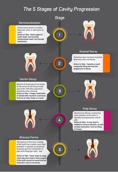 The five stages of cavity progression. Dental Pictures, Oral Health Education, Dental Health Care, Dental Hygiene School