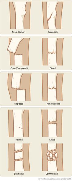 Studying made easy. Types Of Fractures, Muzică Rock, Studera Motivation, Bone Fracture, Medical School Studying, Nursing School Notes, Medical Terminology