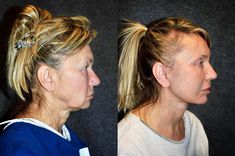 Neck Rejuvenation, Youthful Face