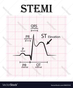 the stemi diagram on a white background