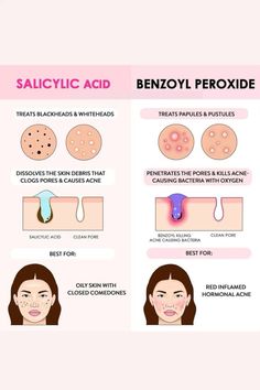 If you have any of this acne in my page i have the right product you need to fight this acne. Benzoyl Peroxide