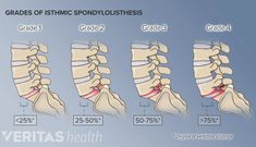 All about L5-S1 (Lumbosacral Joint) | Spine-health Lumbar Lordosis, Nerve Anatomy, Animated Anatomy, Piriformis Stretch, Wellness Videos, Spinal Nerve, Spine Surgery