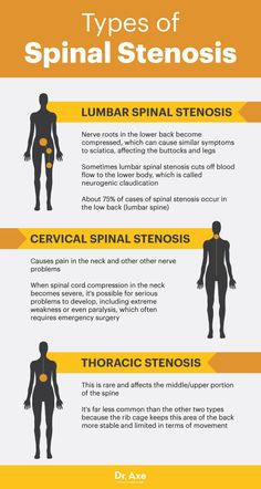 I have cervical spinal stenosis Stenosis Exercises, Nerve Problems, Back Pain Remedies, Spine Health, Sciatic Nerve Pain, Carpal Tunnel, Nerve Pain, Sciatica, Health Info