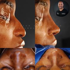 Noses Reference Drawing, Noses Reference, Lips Injection, Nose Jobs, Storm Marvel