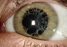 the iris of an eye with black and white markings