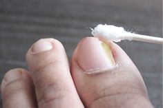 How to Get Rid of an Ingrown Toenail at Home? Vic Vaporub, Infected Toenail, Vicks Vapor Rub, Nail Fungus Remedy