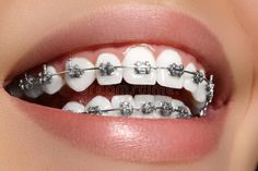 Smile With Braces, Braces Smile, Ceramic Braces, Braces Cost, Types Of Braces, Braces Tips, Getting Braces, Teeth Alignment, Traditional Braces