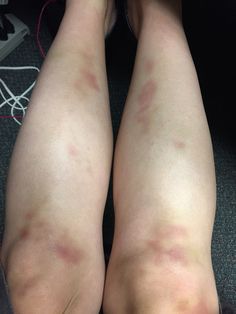 the legs and ankles of a woman with varicous on her leg, sitting in an office chair