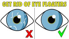 The 2 step solution to naturally get rid of eye floaters Eye Floaters, 2 Step, Good Health Tips, Natural Health Remedies, Dry Eyes