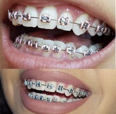 Braces Girls, Clear Braces