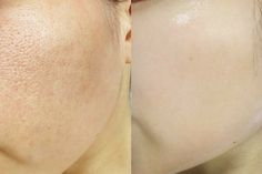 Facial Before And After, Skin Poster, Face Pores, Best Acne Products, Dark Spots On Face, Beauty Tips For Face, Facial Skin Care Routine