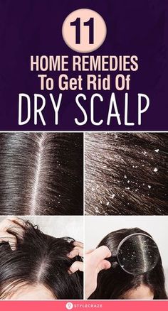 Get Rid Of Dry Scalp, Remedies For Dry Scalp, Itchy Flaky Scalp, Dry Flaky Scalp, Home Remedies For Dandruff, Scalp Moisturizer, Dandruff Remedy