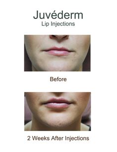 Before and after Juvederm, a dermal filler, lip injections (2 weeks post injection) Aesthetics Business, Dermal Fillers Lips, Filler Lip, Cheek Fillers, Lip Wrinkles, Lip Enhancement