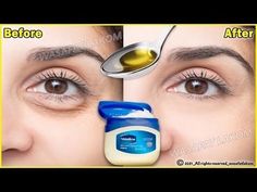 Eye Wrinkles Remedies, Puffy Bags, Face Wrinkles Remedies, Puffy Eyes Remedy, Wrinkles Remedies Face, Bags Under Eyes, Remove Eye Bags, Mascara Hacks, Wrinkle Remedies