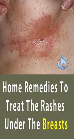 Skin Rash Remedies, Home Remedies For Rashes, Yeast Infection On Skin, Rashes Remedies, Heat Rash, Rash Cream, Itch Relief, Home Health Remedies, Matcha Green