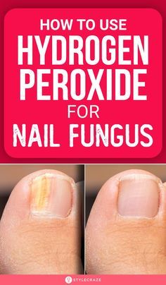 Nail Fungus Remedies, Foot Soak Recipe, Nail Remedies, Peroxide Uses, Foot Soaks, Toenail Fungus Remedies, Nail Infection, Nails Health