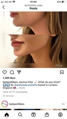 Jaw Line Fillers Before And After, Face Fillers Before And After, Chin Lipo Before And After, Jaw Filler Before And After, Face Contouring Fillers, Botox Jawline Before And After, Fillers Before And After, Jawline Fillers Before And After, Chin Fillers Before After