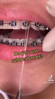 Rubber Band Colors For Braces, How To Put Braces On Teeth, Braces Band Colors, Color Braces Ideas, Braces With Rubber Bands, Pretty Braces Colors, Braces Colors Aesthetic, Black Braces Bands, Dental Braces Colors