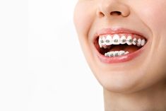 How Do I Care For My Teeth While Wearing Braces? #braces #orthodontictreatment #allsmilesdentalspa Orthodontics Teeth, Dental Animation, Dentist Art, Straight Smile, Dental Social Media, Dental Images, Dental Spa, Orthodontic Appliances