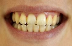 It isn’t just smokers who suffer from stained teeth. Find out the various causes of tooth-staining and how you can restore your smile to its youthful brightness. #Stained #teeth. Whiten Teeth Fast, Teeth Whitening Remedies, Whiter Teeth, Yellow Teeth, Stained Teeth, Natural Teeth Whitening, Whitening Toothpaste, White Teeth, Healthy Teeth