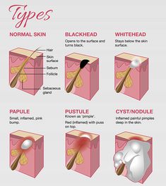 Acne Types, Hair Knowledge, Painful Pimple, Skin Anatomy, Medical Esthetician, Skin Advice, Skin Aesthetics, Types Of Acne