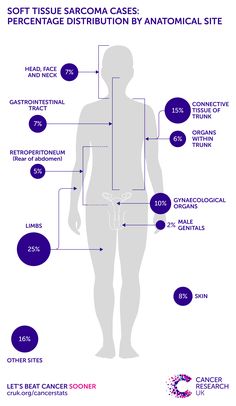 Soft tissue sarcoma incidence statistics | Cancer Research UK Soft Tissue Sarcoma, Chemo Tips, Health Infographics, Health Professionals, Health Food, Healing