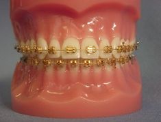 Different Types Of Braces, Types Of Braces, Straight Smile