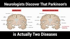 Parkinson Diet, Anterior Placenta, Benefits Of Sleeping, Parkinsons Awareness, Loss Of Balance, Disease Symptoms, Medicine Book, Neurological Disorders, Medical News