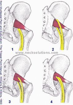 Piriformis Syndrome Is A Common Cause Of Sciatica Pain, Often Mistaken For Disc Herniation - Causes & Treatment Piriformis Syndrome Symptoms, Piriformis Syndrome Exercises, Sciatic Nerve Exercises, Best Exercise For Hips, Disc Herniation, Sciatica Stretches, Bursitis Hip, Piriformis Muscle, Hip Pain Relief