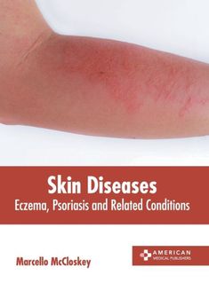 The conditions that affect the skin are called as skin diseases. There are various types of skin diseases and disorders, such as acne, eczema, alopecia areata, epidermolysis bullosa, hidradenitis suppurativa (HS), ichthyosis, pachyonychia congenita, etc. Eczema and psoriasis are common chronic inflammatory skin diseases. Both psoriasis and eczema result in red, itchy scaly patches on the skin. Psoriasis is related to rheumatologic (psoriatic arthritis), cardiovascular, metabolic, hepatic, and psychiatric diseases whereas eczema is related to higher rates of mental health symptoms and disorders that include depression, anxiety, attention-deficit (hyperactivity) disorder, and sleep dysregulation. Both are caused by a complex interplay between skin-barrier disruption, immune dysregulation, ho Diseases And Disorders, Epidermolysis Bullosa, Mental Health Symptoms, Types Of Skin, Attention Deficit, Skin Diseases, Skin Barrier, Disease