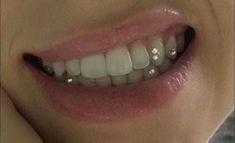 a woman's smile with braces on her teeth