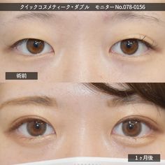 Eye Surgery, Makeup, Beauty, Make Up