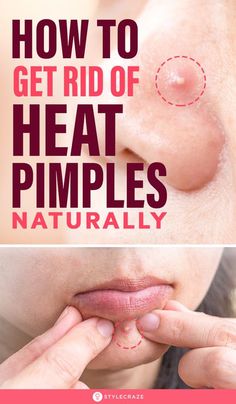 Leg Pimples, Red Spots On Face, Reduce Face Redness, Red Skin Spots, Remedies For Pimples, Forehead Bumps, Acne Scar Diy, Sagging Cheeks, Warts Remedy