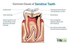 DIY Toothpaste for sensitive teeth Nerve Pain Remedies, Wisdom Teeth Pain, Home Remedies For Sinus, Cracked Tooth, Dental Decay