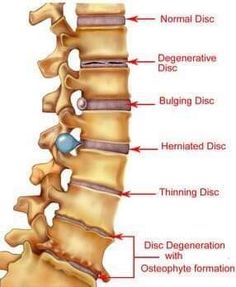 Bolesti Chrbta, Bulging Disc, Back Pain Remedies, Spine Health, Sciatica Pain, Medical Anatomy, Sciatic Nerve, Chiropractic Care, Medical Knowledge