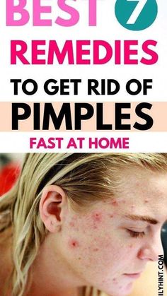 Pimple Remedies, Remedies For Pimples, Pimples On Scalp, Get Rid Of Pimples Overnight, Rid Of Pimples Overnight, Natural Remedies For Pimples, Pimples On Buttocks, Home Remedies For Pimples, Get Rid Of Pimples