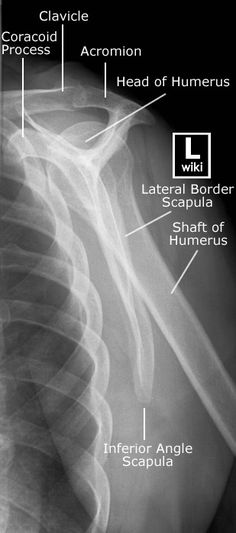 an x - ray shows the location of the shoulder and other parts of the arm