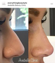 Big Nose Before And After, Best Noses, Nose Job Inspo Natural, Beautiful Noses Woman, Straight Nose Aesthetic, Ideal Nose Rhinoplasty, Straight Nose Side Profile, Nose Job Front View, Nose Job Inspiration Natural