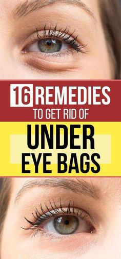 16 Remedies To Get Rid Of Under Eye Bags: One of the most likely causes of under-eye bags is exhaustion. Other typical factors include stress and water retention. Getting rid of puffy eyes is a simple task that can be easily done at home. Keep reading to learn about some simple and natural cures for eye bags. Eye Bag Remedies, Puffy Eyes Remedy, Droopy Eyelids, Remove Dark Circles, Under Eyes, Dark Circles Under Eyes, Sciatic Nerve, Eye Wrinkle, Under Eye Bags