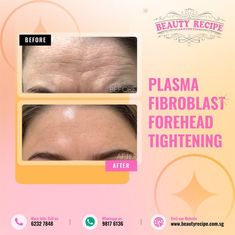 plasma fibroblast treatment Plasma Fibroblast, Eyelid Lift, Eye Lift, Anti Aging Treatments, Beauty Recipe, Surgery, Anti Aging, Singapore, Art Painting