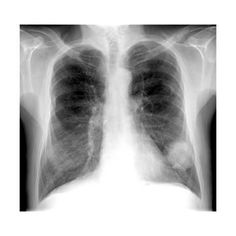 an x - ray shows the chest and lungs