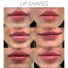 Lip Fillers Juvederm, Lip Types, Face Fillers, Being Unique, Facial Contouring, Lip Augmentation