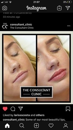 Lip Flip And Filler Before And After, Lip Blushing Before And After, Natural Lip Fillers Before And After, Hip Filler, Subtle Lip Filler Before And After, Lip Flip Botox Before And After