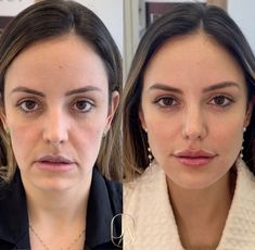 Botched Plastic Surgeries, Facial Harmony, Facial Before And After, Nose Surgery Rhinoplasty, Botched Plastic Surgery, Lip Lift