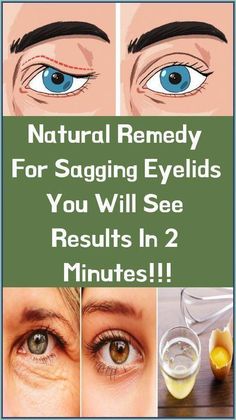 Natural Remedy for Sagging Eyelids - You Will See Results in 2 Minutes! by Blage Tristian | This newsletter was created with Smore, an online tool for creating beautiful newsletters for educators, businesses and more Sagging Eyelids, Droopy Eyelids, Diy Remedies, Natural Therapy, Natural Diy, Natural Remedy, Natural Home Remedies, Natural Healing, Home Remedies