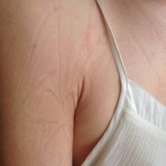 the back of a woman's breast showing signs of blemish on it