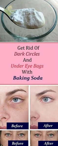 Eye bags: 1. Add 1 teaspoon of backing soda in a glass of hot water or tea and mix it well. 2. Take a pair of cotton pads and soak them in the solution and place them under the eye. 3. Let it sit for 10-15 minutes, then rinse it off and apply a moisturizer Practicing this procedure daily will render amazing results in just a week. Obličejové Masky, Remove Dark Circles, Under Eye Bags, روتين العناية بالبشرة, Beauty Remedies, Skin Remedies, Eye Bags, Homemade Beauty Products, Face Skin Care