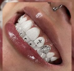 a woman's mouth with braces and teeth